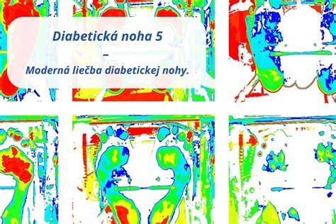 Prehľad komplikácií diabetickej nohy