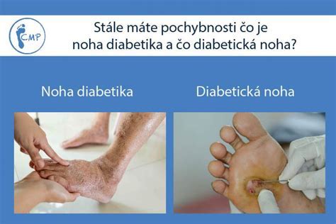 Porovnanie neuropatických a ischemických vredov na diabetickej nohe