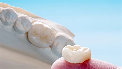 Zubné korunky a mostíky upevnené dentálnym cementom