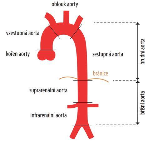 Schéma hybridnej rekonštrukcie aortálneho oblúka