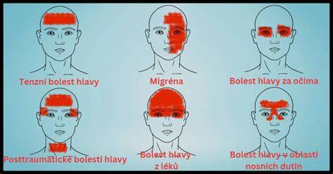 Mapa lokalizácie bolesti hlavy