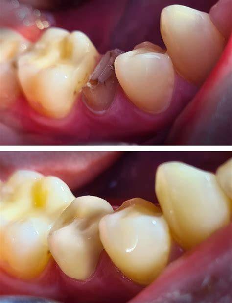 Porovnanie prirodzeného zuba a CEREC korunky