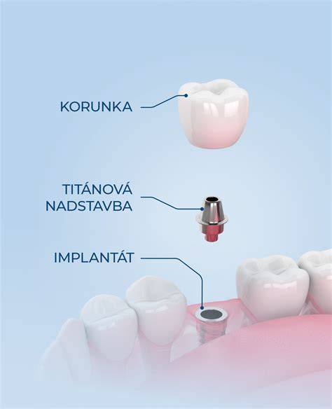 Diagram zubného implantátu v kosti