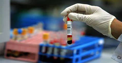 Laboratórne vyšetrenie krvného náteru pod mikroskopom