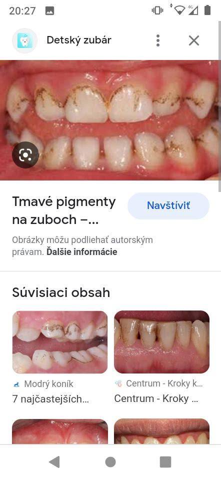 Schéma umiestnenia ortodontických zámkov a drôtikov na zuboch