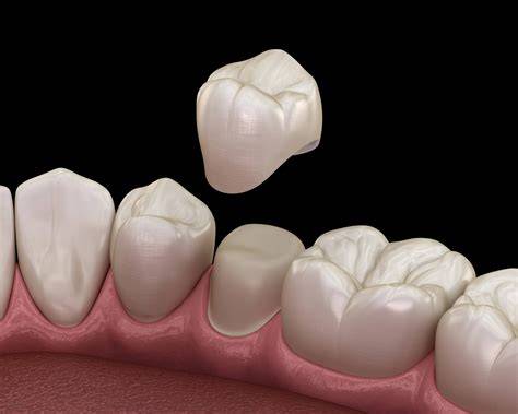 Zubná korunka CEREC na implantáte