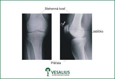 Anatómia kolena a predného skríženého väzu (ACL)