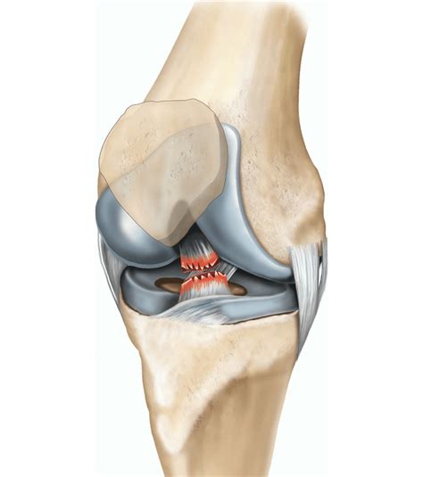 Symptómy a diagnostika ACL