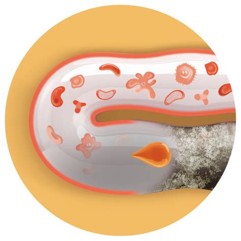 Schéma narušenia črevnej mikroflóry antibiotikami