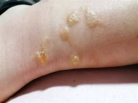 Závažná alergická reakcia po uštipnutí hmyzom