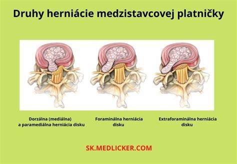 Schéma medzistavcovej platničky a jej štruktúry
