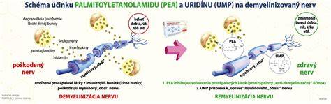Infografika zobrazujúca rôzne spôsoby liečby útlaku nervu