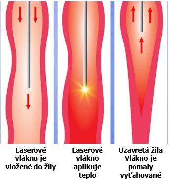 Laserová operácia kŕčových žíl